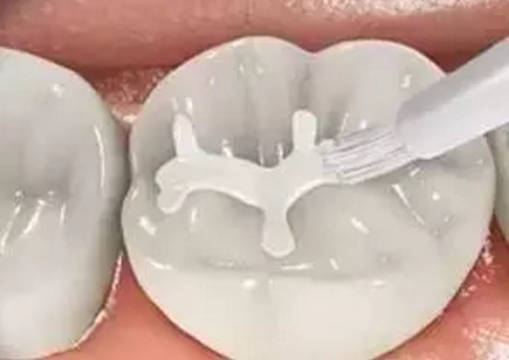 卫生部制作宣传片,带你了解儿童保护牙齿(图1) 深圳宣传片制作公司口腔牙齿的沟隙的方式